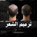 ترميم معالج ضد الهيشان والتساقط